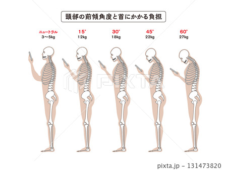 ストレートネック （スマホ首）頭部の傾斜角度と首への負担 131473820