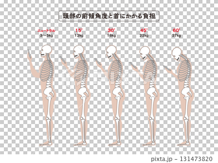 直頸(智慧型手機頸)頭部傾斜角度和頸部勞損 直頸(智慧型手機頸)頭部傾斜角度和頸部勞損 131473820