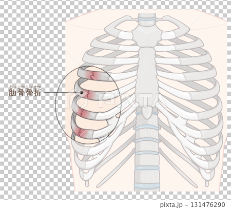 Broken rib illustration Broken rib illustration 131476290