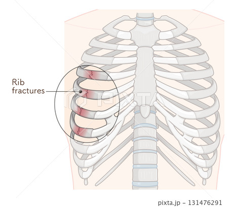 肋骨骨折のイラスト　Broken rib illustration 131476291