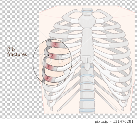 肋骨骨折のイラスト　Broken rib illustration 131476291