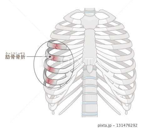 肋骨骨折のイラスト　Broken rib illustration 131476292