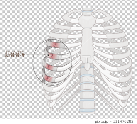 肋骨骨折のイラスト　Broken rib illustration 131476292
