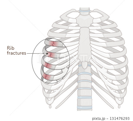 肋骨骨折のイラスト　Broken rib illustration 131476293