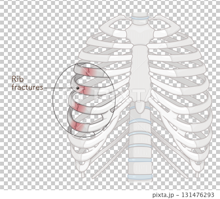 肋骨骨折のイラスト　Broken rib illustration 131476293