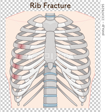 肋骨骨折圖 肋骨骨折圖 131476295