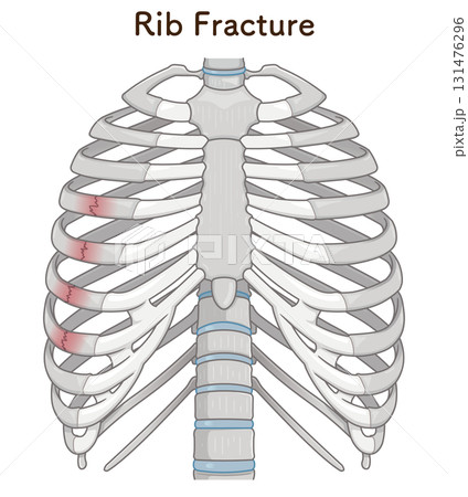 肋骨骨折のイラスト　Broken rib illustration 131476296
