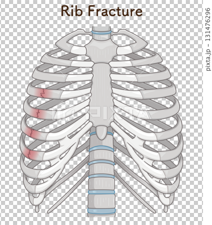 肋骨骨折のイラスト　Broken rib illustration 131476296