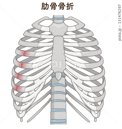 肋骨骨折のイラスト　Broken rib illustration 131476297