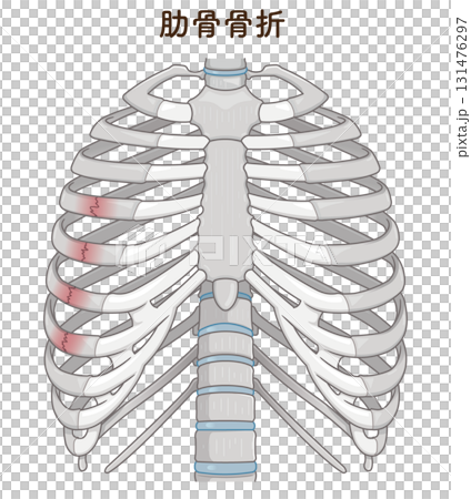 肋骨骨折のイラスト　Broken rib illustration 131476297