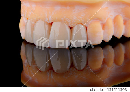 High-quality four dental crowns made of zirconium for fixation to the frontal teeth of upper jaw. High-quality four dental crowns made of zirconium for fixation to the frontal teeth of upper jaw. 131511308