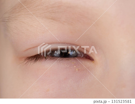 Painful red eye of a girl during a viral cold. Inflammation conjunctivitis, macro 131523581