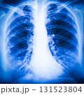 Clear chest X-ray showing lung structure and heart silhouette with distinct details 131523804