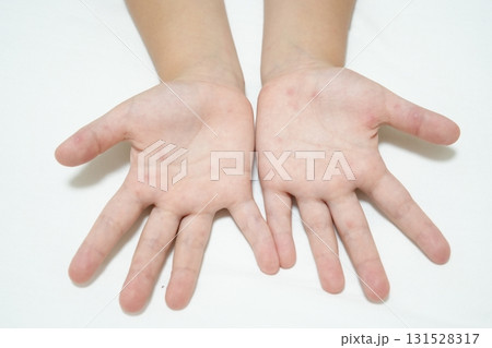 手足口病の発疹が見られる子どもの手足(医療・感染症イメージ) 手足口病の発疹が見られる子どもの手足(医療・感染症イメージ) 131528317