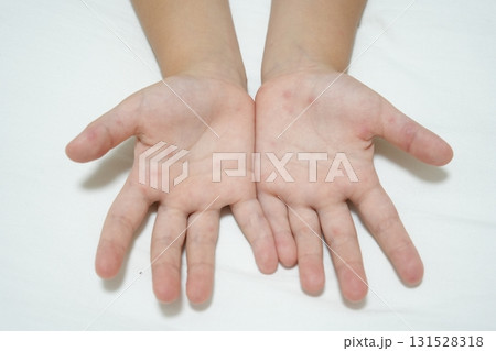 手足口病の発疹が見られる子どもの手足（医療・感染症イメージ） 131528318