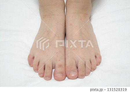 手足口病の発疹が見られる子どもの手足（医療・感染症イメージ） 131528319