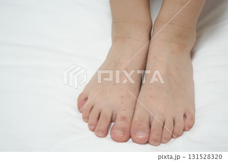 手足口病の発疹が見られる子どもの手足（医療・感染症イメージ） 131528320