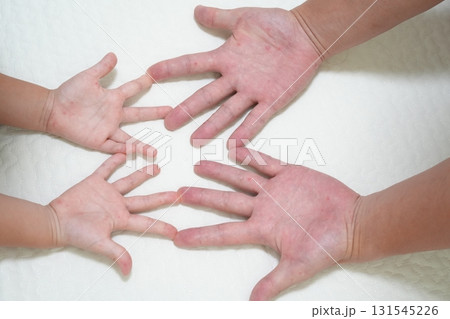 親子に見られる手足口病の発疹（医療・感染症啓発イメージ） 131545226