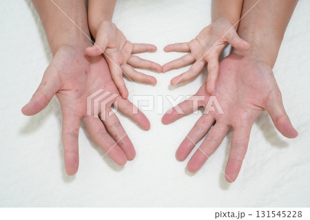 親子に見られる手足口病の発疹（医療・感染症啓発イメージ） 131545228