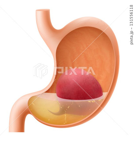 Human Stomach with beetroot. The stomach digests beets. A stomach filled with healthy and wholesome food. Proper nutrition. Realistic 3d Vector illustration. Food digestion process illustration Human Stomach with beetroot. The stomach digests beets. A stomach filled with healthy and wholesome food. Proper nutrition. Realistic 3d Vector illustration. Food digestion process illustration 131556118