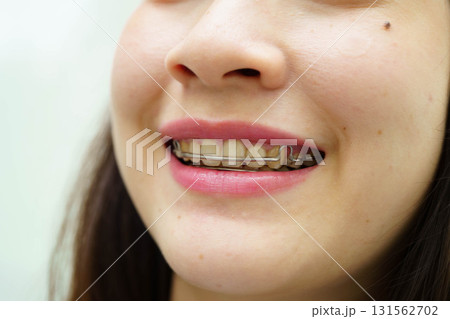 Asian woman with dental braces orthodontic treatment dental care. Asian woman with dental braces orthodontic treatment dental care. 131562702