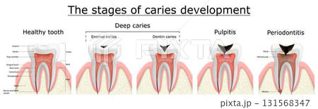 Stages of caries development. Dental disease: caries, pulpitis and periodontitis, realistic vector illustration 131568347