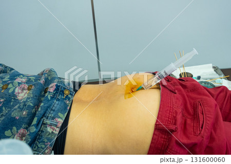 Side view of an intravertebral injection in female patient to treat pain from degenerative disc disease. 131600060
