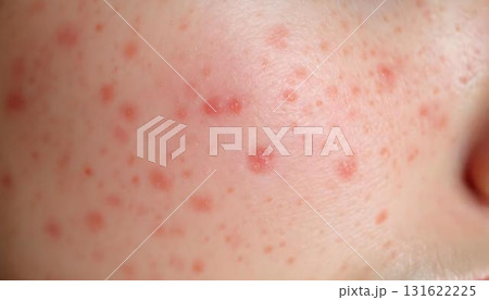 A woman with acne on her face, emphasizing skin health and dermatology, set against a simple background A woman with acne on her face, emphasizing skin health and dermatology, set against a simple background 131622225