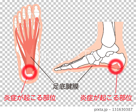 足底筋膜 足底腱膜 足底筋膜炎 足の筋肉 足底筋膜 足底腱膜 足底筋膜炎 足の筋肉 131630387
