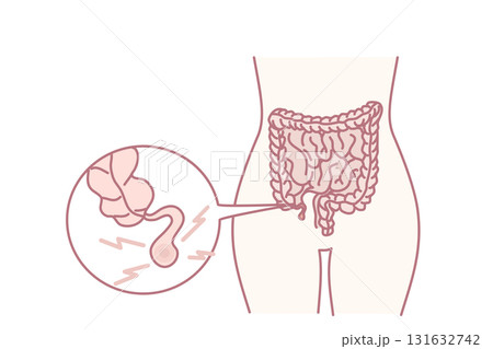 Human body with inflamed appendicitis 131632742