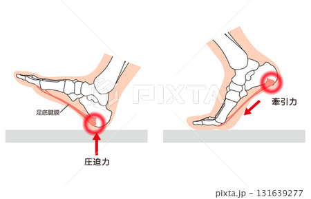 足底筋膜炎 足底筋膜 足底腱膜 足の筋肉 足底筋膜炎 足底筋膜 足底腱膜 足の筋肉 131639277