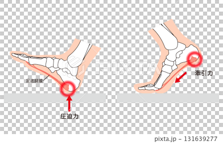 足底筋膜炎 足底筋膜 足底腱膜 足の筋肉 足底筋膜炎 足底筋膜 足底腱膜 足の筋肉 131639277
