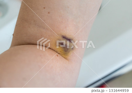 Bruise on arm after blood test, hematoma Bruise on arm after blood test, hematoma 131644959