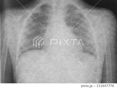 X-ray of the lungs of a sick child. Health examination for suspected bronchitis and pneumonia 131647776