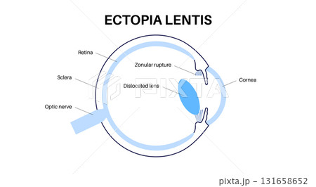 Ectopia lentis disease Ectopia lentis disease 131658652
