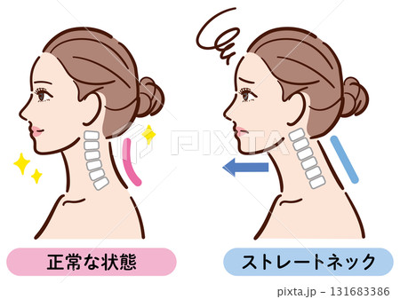 正常な状態とストレートネックの比較イラスト(女性横顔) 正常な状態とストレートネックの比較イラスト(女性横顔) 131683386