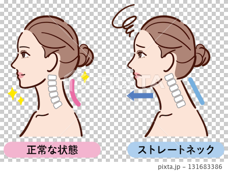 Illustration comparing normal and straight neck (female profile) 131683386