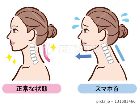 正しい姿勢とスマホ首の比較イラスト（女性横顔） 131683466