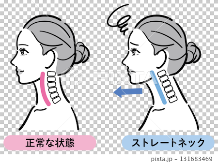 Illustration comparing correct posture and straight neck (female profile) 131683469