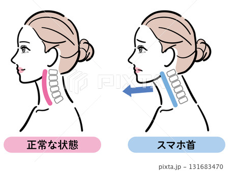 正しい姿勢とスマホ首の比較イラスト（女性横顔） 131683470