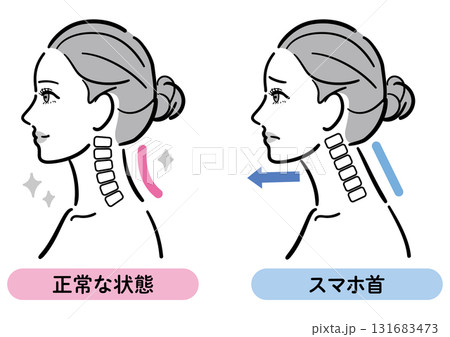 正常な状態とスマホ首の比較イラスト（女性横顔） 131683473