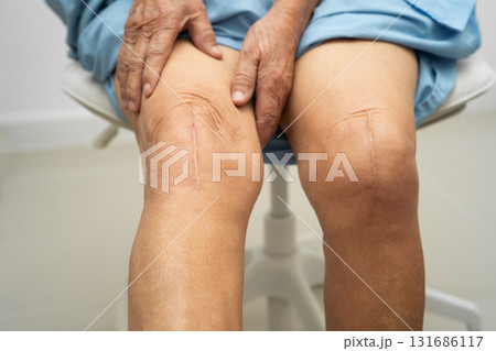 Asian elderly woman patient with scar knee replacement surgery in hospital. Asian elderly woman patient with scar knee replacement surgery in hospital. 131686117