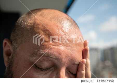 Man forehead sunstroke sweat on face, bald head. Guy suffers from heat high temperature, overheating 131687498