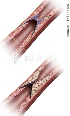 Healthy vs Atherosclerotic Coronary Artery Comparison 131727480