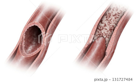Healthy vs Atherosclerotic Coronary Artery Comparison Healthy vs Atherosclerotic Coronary Artery Comparison 131727484