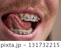Man licking teeth with orthodontic brackets. Dental braces treatment. 131732215