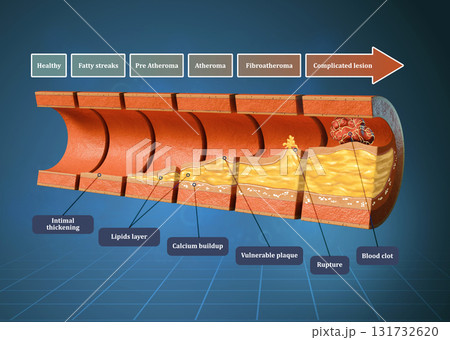 Coronary atherosclerosis timeline 131732620