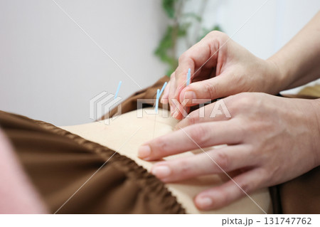 鍼灸 腰鍼治療 鍼灸 腰鍼治療 131747762