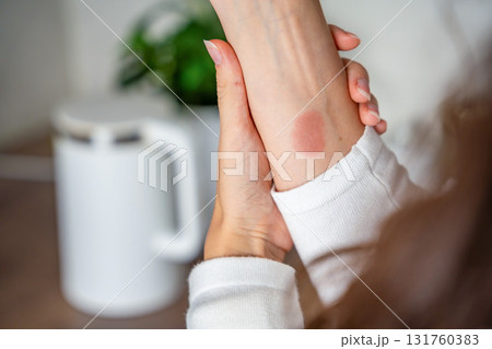 Close up view of scald burn on a hand caused by steam from a kettle in a kitchen. Domestic accident illustrating the danger of hot appliances. 131760383