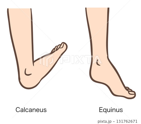 足関節の変形、踵足と尖足 131762671